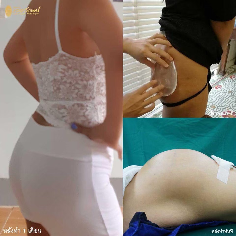 Buttock Augmentation Gallery Lelux Hospital